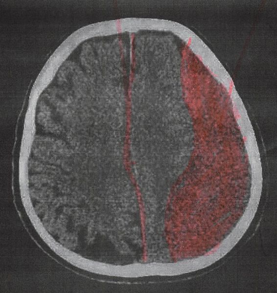 Hirnblutung/chronisches Subduralhämatom - die Neurochirurgie ist präpotent und die Neurologie naiv. Teil 2